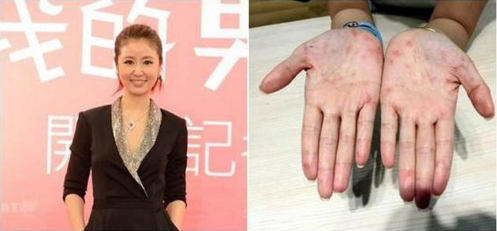 林心如,林心如长满红疹,皮疹,林心如长满红疹仍坚持工作
